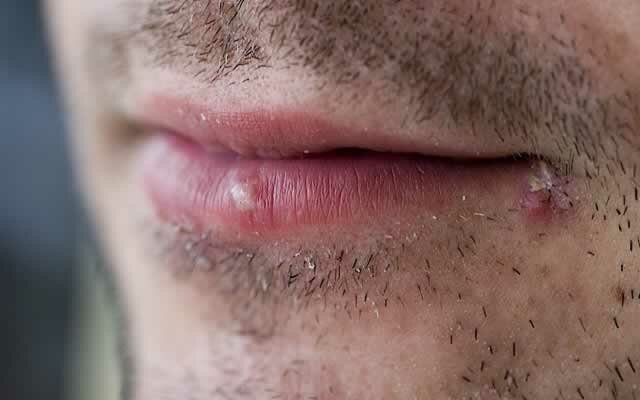 1_how-to-treat-cold-sores