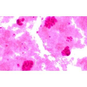 Scientists may have discovered how to stop breast cancer from growing